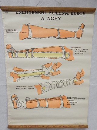 Znehybnění kolena, bérce a nohy